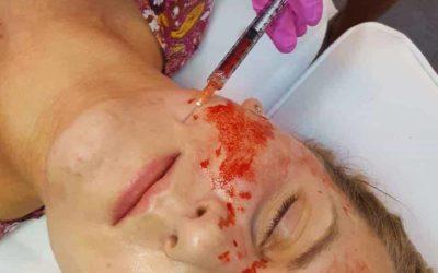 Osocze bogatopłytkowe – co należy wiedzieć?