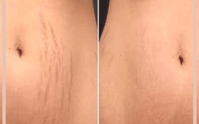 Jak pozbyć się rozstępów?