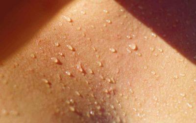 Nadpotliwość na ciele? Jak sobie z nią radzić?