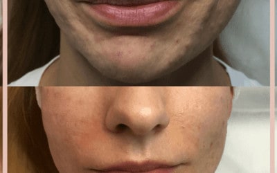 Komórki macierzyste CGF na twarz