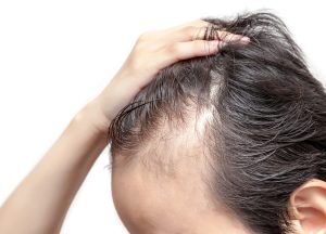 Łysienie androgenowe najczęstszą przyczyną wypadania włosów