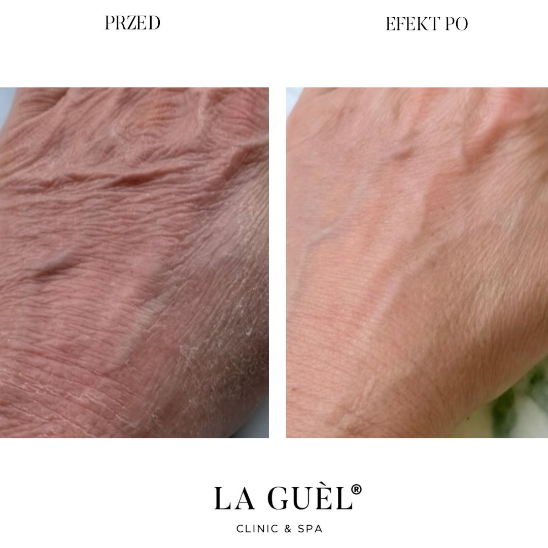 Efekt przed i po skóra