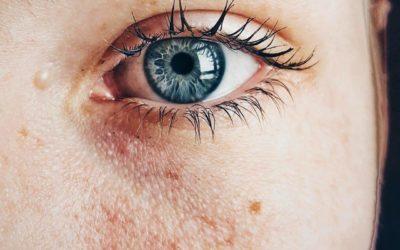 Przebarwienia – przyczyny powstawania i sposoby na pozbycie się problemu