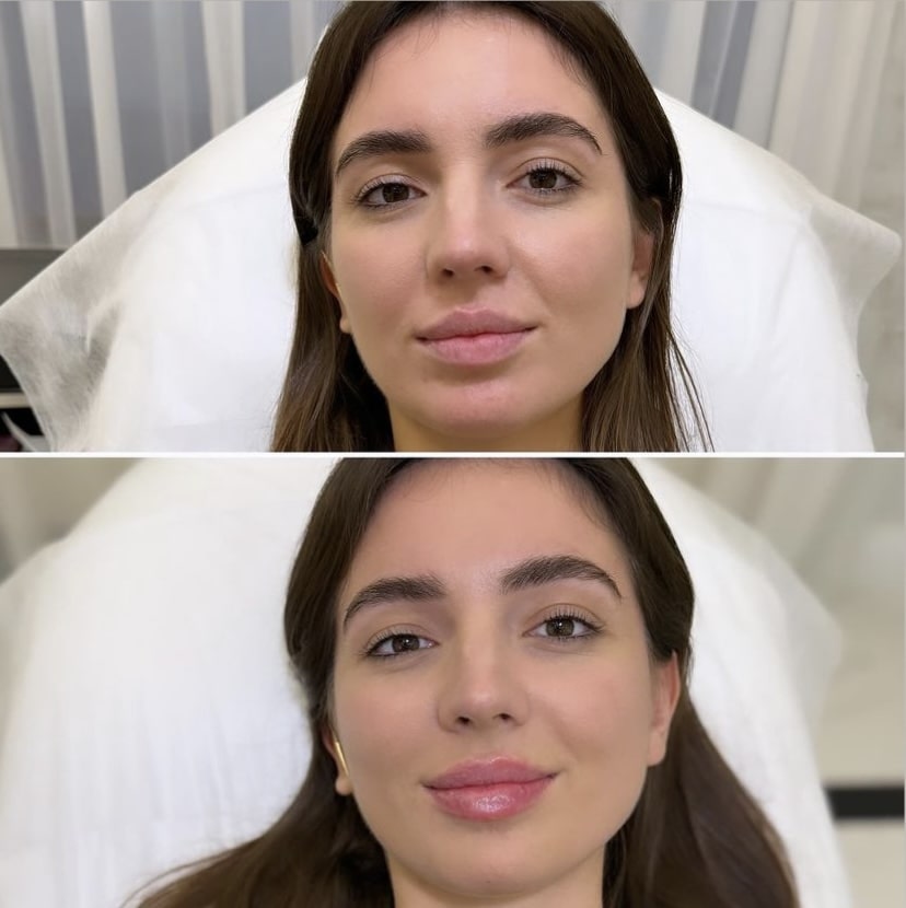 Efekty przed po min Efekty zabiegów na twarz i ciało Przed i Po
