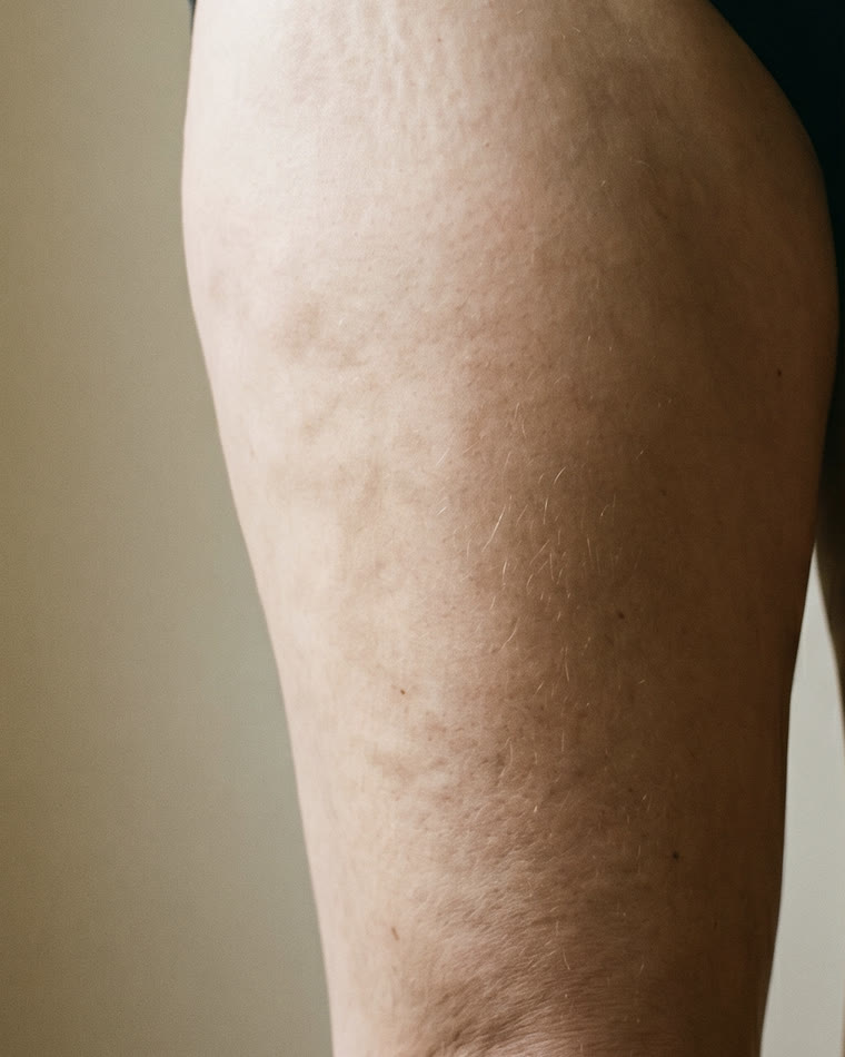 Przed endermologią — cellulit i nierówna skóra na udzie